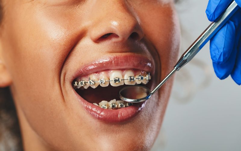 checking-braces-2024-10-20-22-33-22-utc